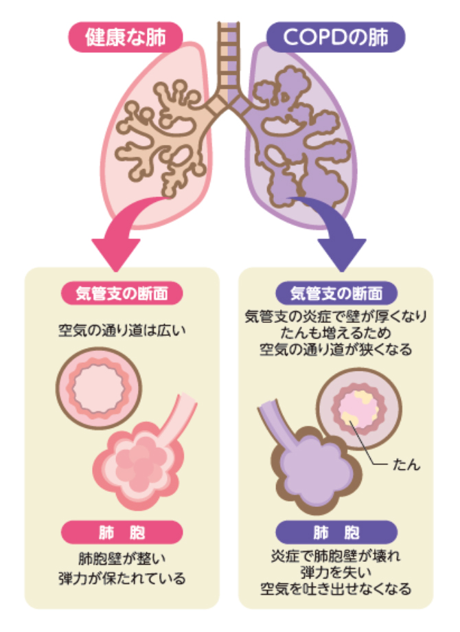 COPDの説明イラスト図