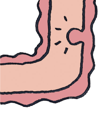 大腸ポリープのイラスト
